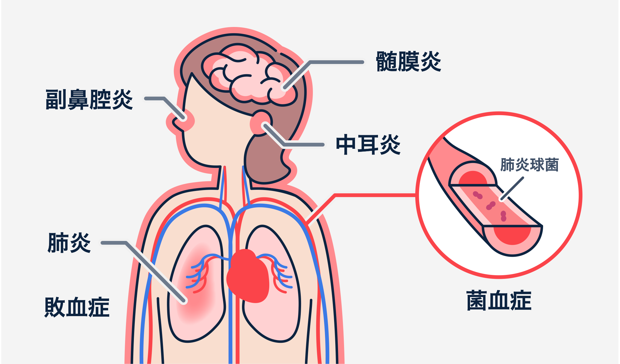 髄膜炎は脳 副鼻腔炎は鼻 中耳炎は耳 菌血縁/敗血症は血管 肺炎は肺